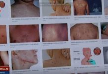 Epidemija ospica malih razmjera u Hrvatskoj