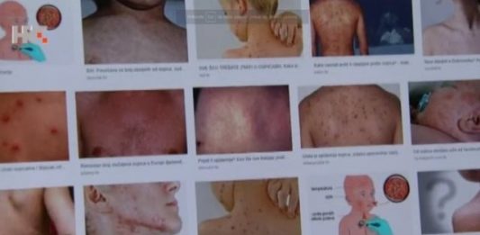 Epidemija ospica malih razmjera u Hrvatskoj